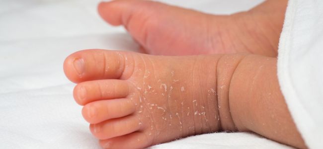 image Penyebab Kulit Bayi Kering dan Mengelupas & Cara Mengatasinya!