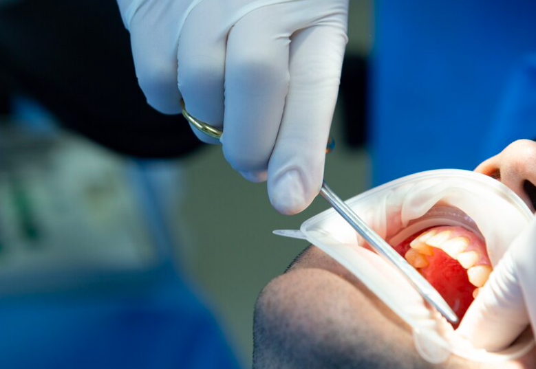 image Perawatan Pasca Operasi Gigi Bungsu yang Dapat Anda Lakukan