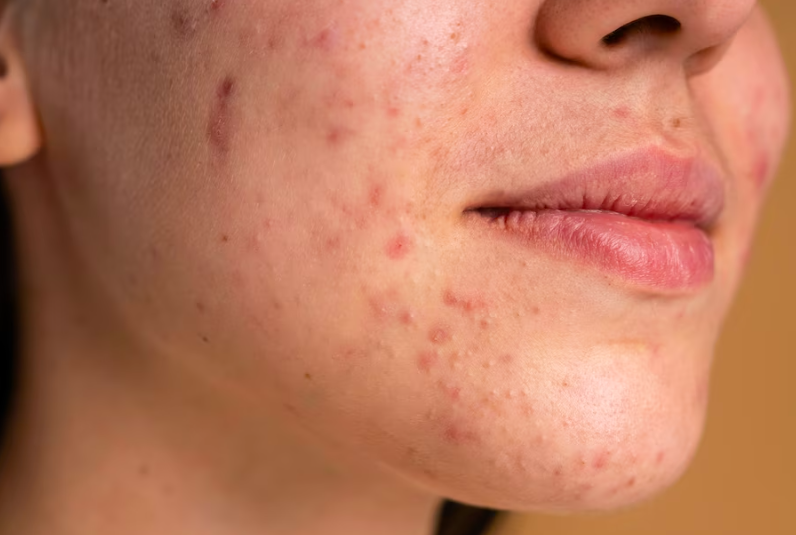 image Praktis, Ini Cara Menghilangkan Jerawat Dan Bekasnya Ala Perempuan Korea!