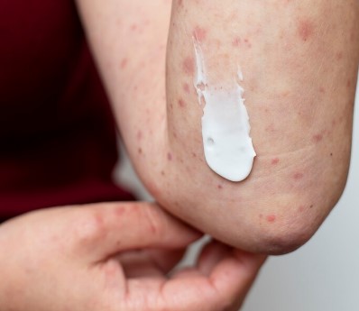 image Rekomendasi Cara Mengobati Bintik Merah Pada Kulit Disertai Gatal