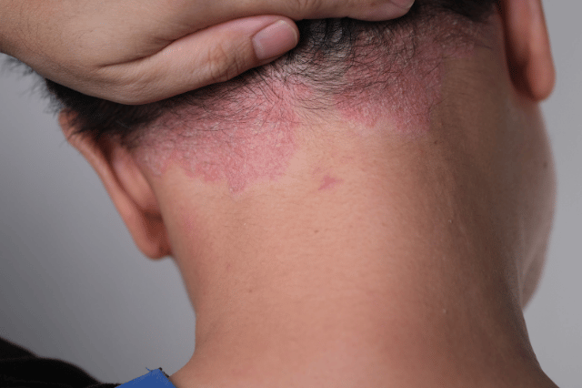 dermatitis seboroik