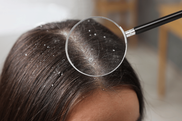 rambut ketombe dan gatal
